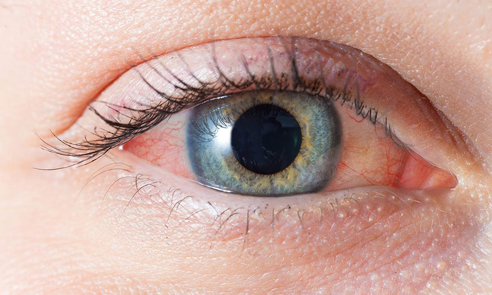 بیماری ماکولای چشمی
